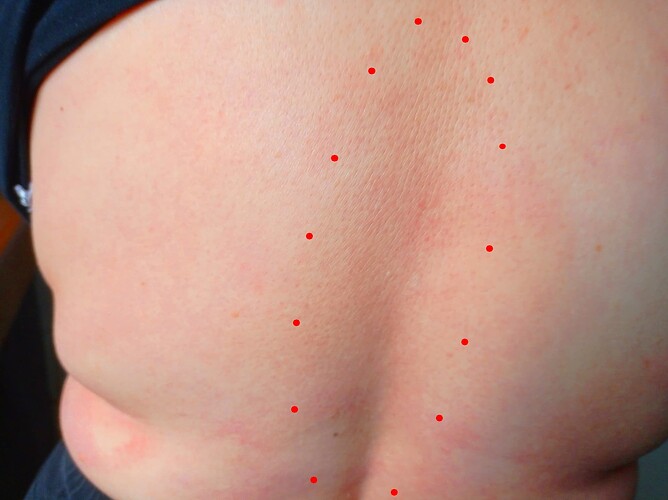 Mycosis fongoïde février 2026 apparition de janvier (3)