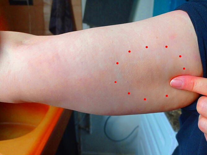 Mycosis fongoïde février 2026 apparition de janvier (5)