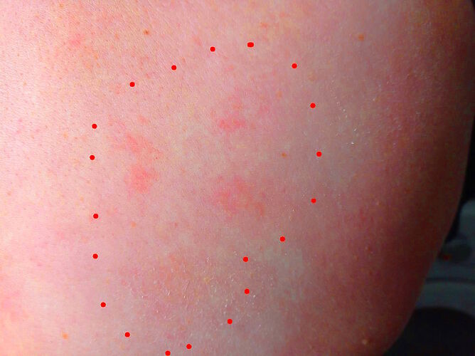 Mycosis fongoïde février 2026 apparition de janvier (2)