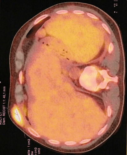 tumeur-hypermétabolique