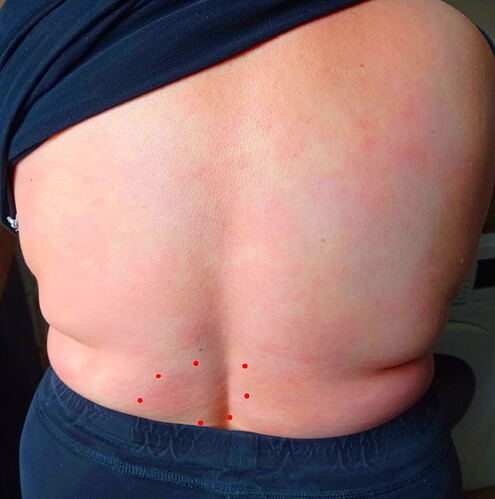 Mycosis fongoïde février 2026 apparition de janvier (1)