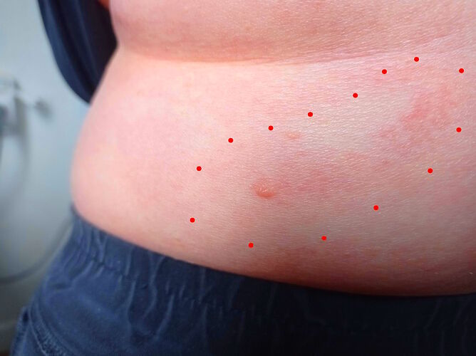 Mycosis fongoïde février 2026 apparition de janvier (4)